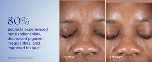 Active Peel System